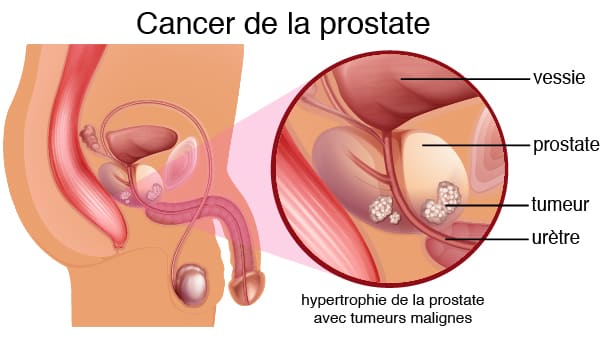 Cancer de la Prostate